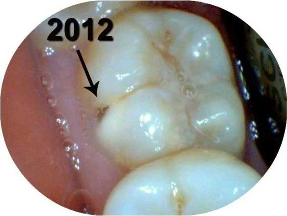 Small cavity starting in 2012 at Picasso Dental Care.