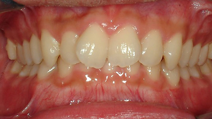 A smile of a patient after braces treatment at Picasso Dental Care. A smile of a patient after braces treatment at Picasso Dental Care.