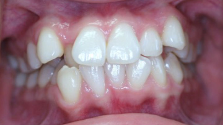 A smile of a patient with before braces at Picasso Dental Care. A smile of a patient with before braces at Picasso Dental Care.