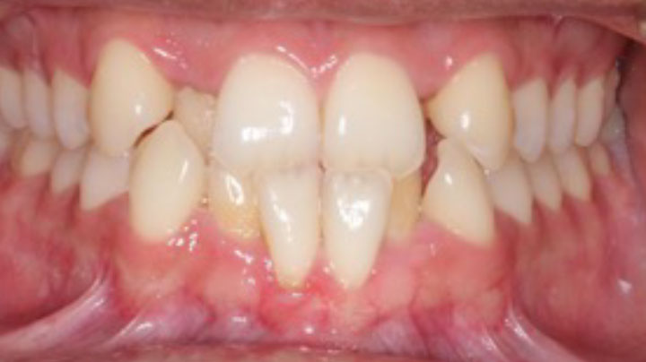 A smile of a patient after partial braces treatment on at Picasso Dental Care. A smile of a patient after partial braces treatment on at Picasso Dental Care.