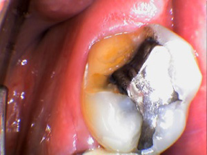 Case 1 of a teeth before crown