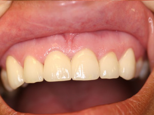 Case 2 of a after before crown