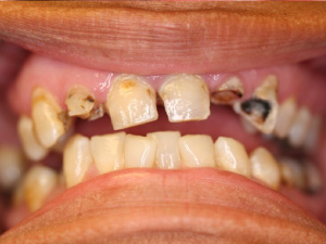 Case 2 of a teeth before crown