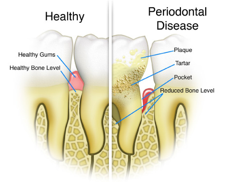 Diagram of helathy and periodontally affected teeth.