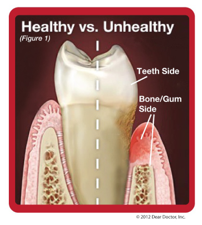 Diagram of periodontal affected tooth and normal tooth.