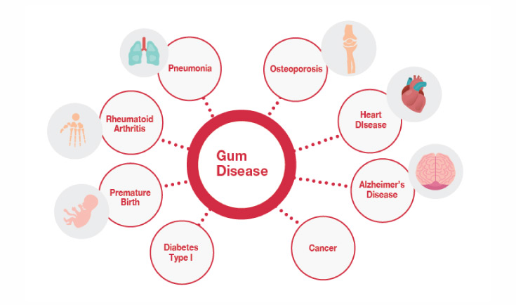Diagram of how periodontal disease affects many other aspects of life and health.