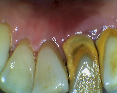 Periodontally affected teeth. Periodontally affected teeth.