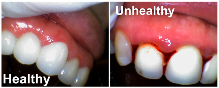 Before and after of healthy and periodontally affected gums and teeth.