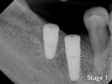 Stage 1 of dental implants