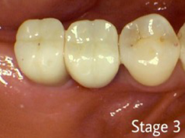 Stage 3 of dental implants