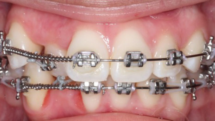 A smile of a patient with braces on at Picasso Dental Care. A smile of a patient with braces on at Picasso Dental Care.