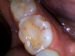 Case of failing dental work where a side of the filled tooth is starting to decay.