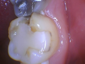 A failing. dental work example, where tooth with a filling is forming cavity in one corner.
