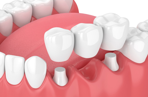 Rendering of jaw with dental bridge at Picasso Dental Care