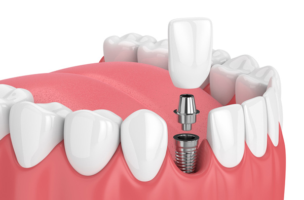 Rendering of jaw with dental implant Rendering of jaw with dental implant