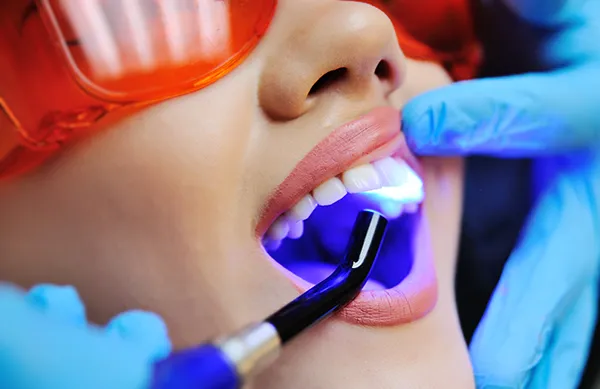 Close up of a dental assistant applying a UV light to a white female patient's newly sealed teeth