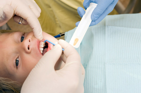 Young boy receiving fluoride treatment at Picasso Dental Care in Temecula, CA