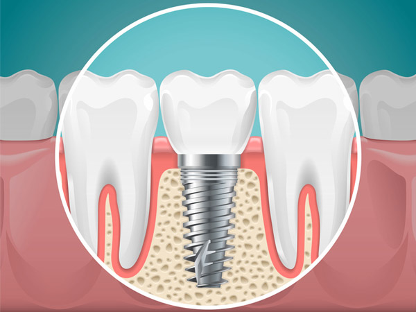 Diagram of a tooth replaced with a dental implant at Picasso Dental Care in Temecula, CA 
