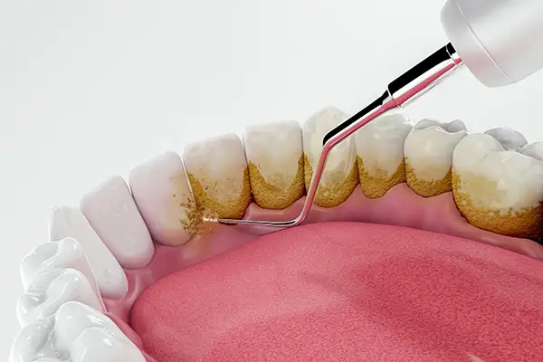Close up 3D rendering of dirty teeth being cleaned and restored by a dental tool at Picasso Dental Care in Temecula, CA 