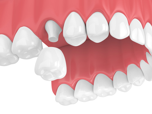 Rendering of jaw with dental crown
